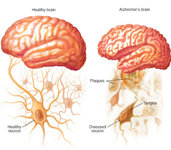 Alzheimer