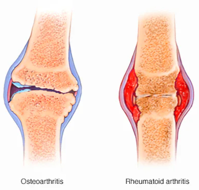 Arthritis