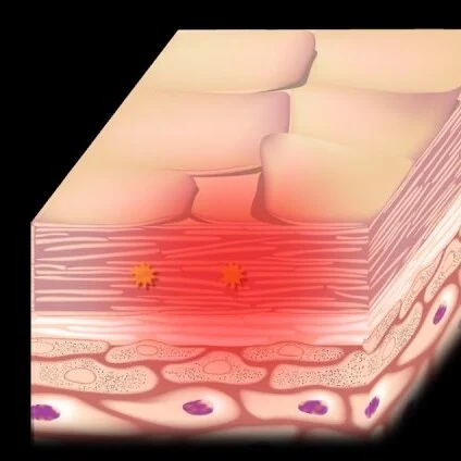 Eczema